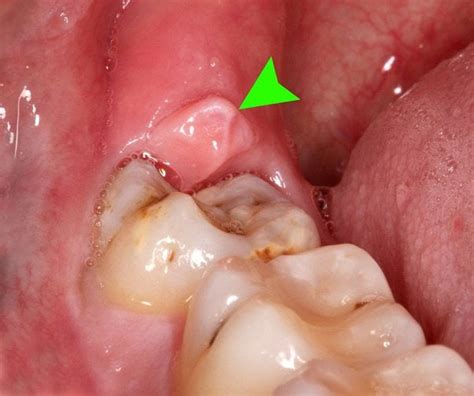 Loose Flap Of Gum Over 2nd Molars Wisdom Teeth Extracted Dentistry