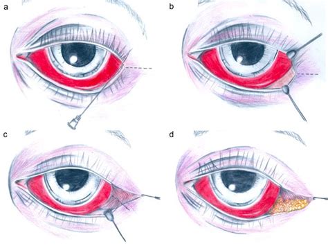 Lateral Canthus Eye Anatomy
