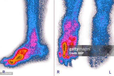 Diabetic Foot Ulcer Photos And Premium High Res Pictures Getty Images