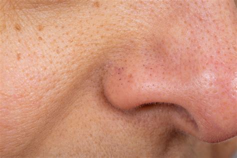How To Get Rid Of Blackheads Safely According To Experts Glamour Uk