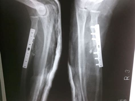Ipsilateral Radial Head Dislocation And Proximal One-Third ...