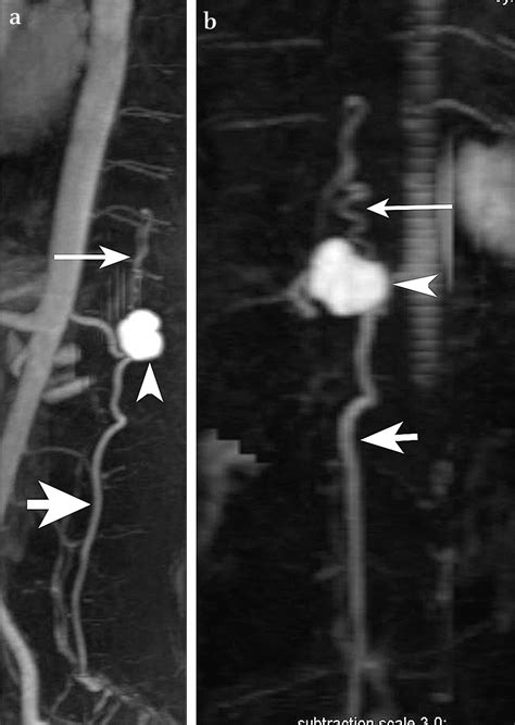 Anterior Spinal Artery Aneurysm Presenting With Spinal Cord Compression