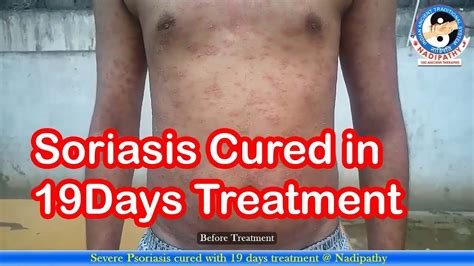 Severe Psoriasis Cured With Just 19 Days Treatment Nadipathy Youtube