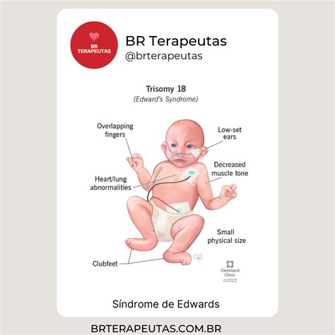 O que é a Síndrome de Edwards Trissomia 18 BR Terapeutas