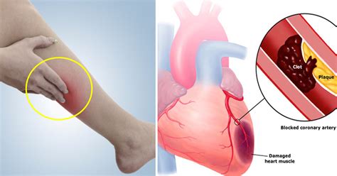 Once you identify symptoms of a blood clot, you should seek medical attention immediately so that your doctor can diagnose and treat the blood. 8 Early Warning Signs Of A Blood Clot You Should Never ...