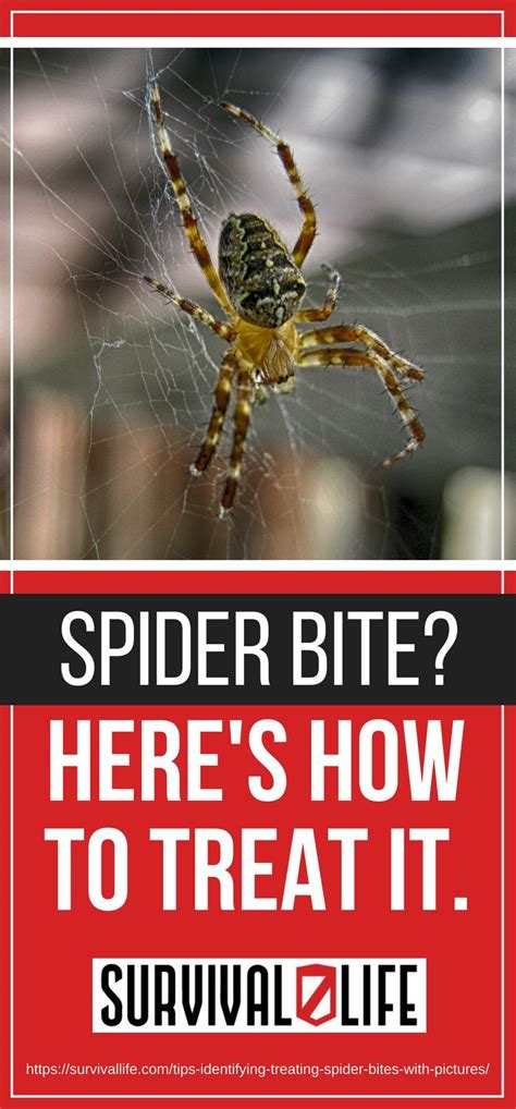 Spider Bite Heres How To Treat It Treating Spider Bites Spider