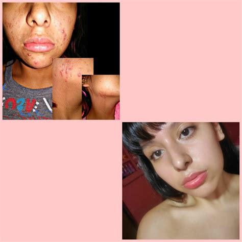 Acne My 1 Yr Skin Progress ♡ I Had No Insurance And Could Not Afford