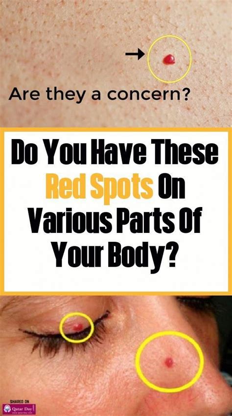 Do You Have These Red Spots On Various Parts Of Your Body In 2020