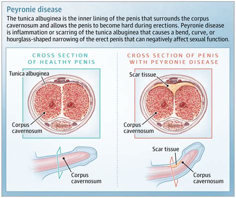 Peyronie Disease Urology Jama Jama Network