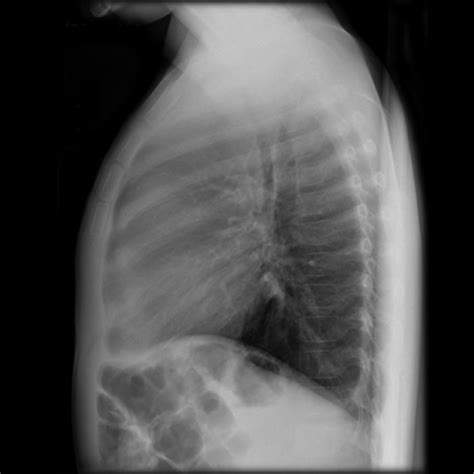 Obliteration Of The Retrosternal Airspace Anterior Mediastinal T Cell