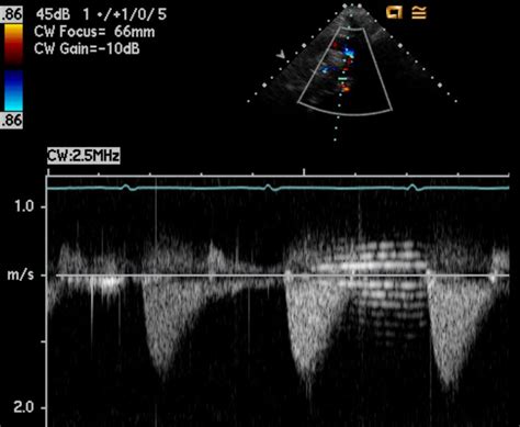 Pedi Cardiology Echo Descending Aorta Doppler Pattern Sp Repair Of