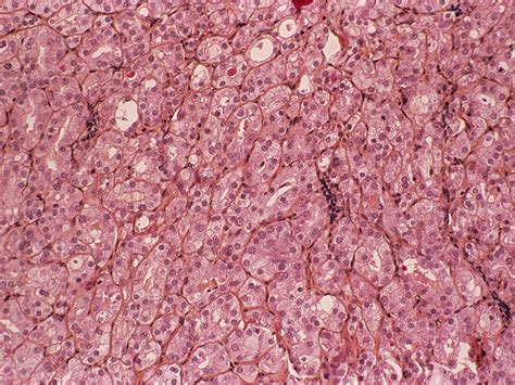 Ed Induced By Prostate Biopsy Likely Underestimated
