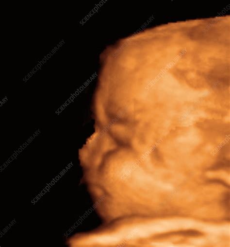 3 D Ultrasound Images