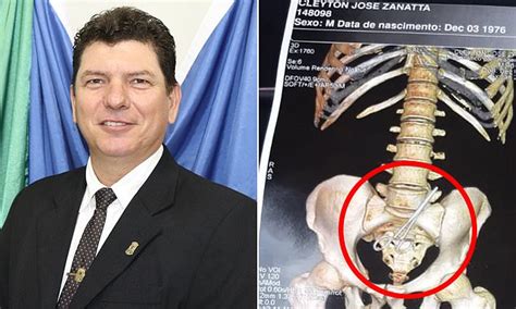 Brazilian Councilman Has Scissors Removed From Abdomen After Surgeon Forgot Them Inside Daily