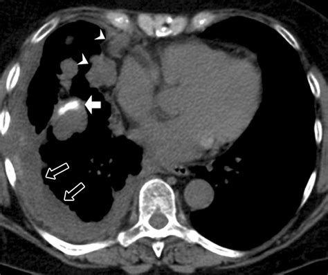 Lesions Of The Cardiophrenic Space Findings At Cross Sectional Imaging