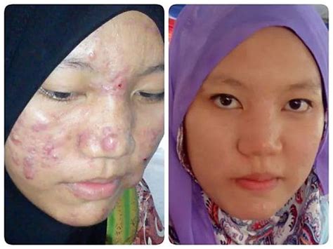 Biji fenugreek bekerja dengan luar biasa untuk menghilangkan bekas jerawat secara alami. Cara Mengatasi Masalah Jerawat