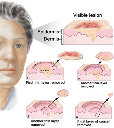 Types Of Skin Cancer Surgery