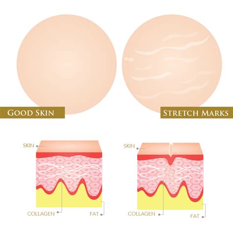 How To Deal With Stretch Marks And Loose Skin Oro Gold School