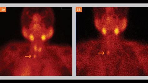 Ectopic Parathyroid Adenoma Diagnosed By Spect Ct Imaging Using 99mtc Mibi