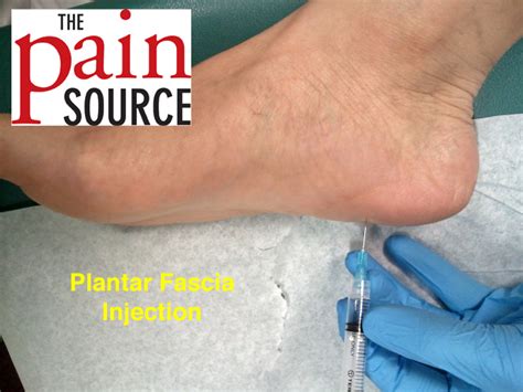 Plantar Fascia Injection Technique And Tips The Pain Source Makes