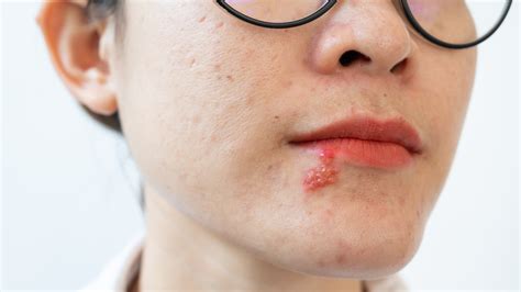 how can you tell if you have herpes vs a pimple