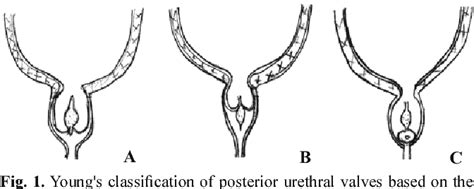 Diagrammatic Representation Of Posterior Urethral Valves