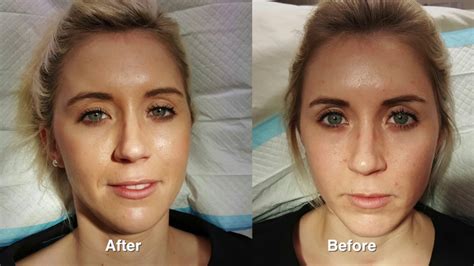 Juvederm Rejuvenation W Before And After Pictures Youtube
