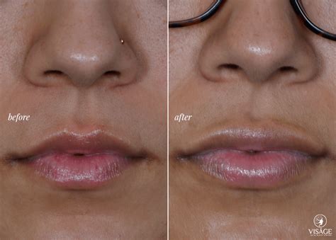 Permalip The Permanent Alternative To Lip Fillers