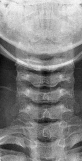 Normal Cervical Spine Xray Bone And Spine