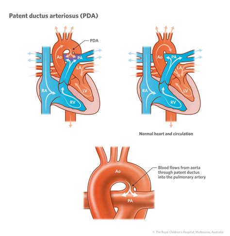 The library is a direct java implementation of the c++ source code. Cardiology : Patent Ductus Arteriosus - PDA