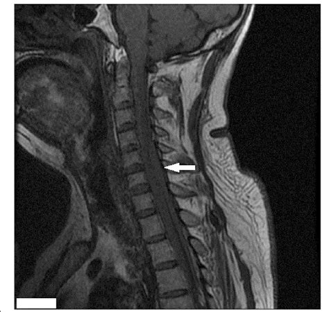 Sagittal MRI Of The Cervical Spine T1 Weighted Image Hypointense