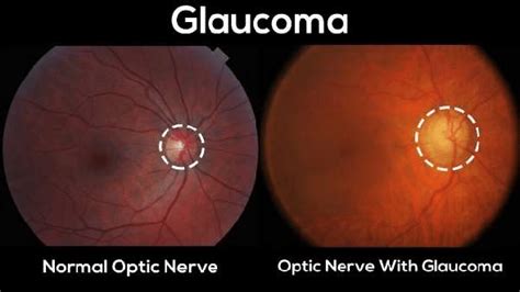 Optic Nerves In Glaucoma And Normal Eye 2 Download Scientific Diagram