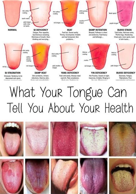 What Your Tongue Can Tell You About Your Health Tongue Health Healthy Tongue Health