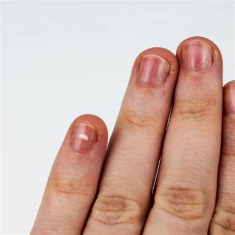 Red Lines On Fingernails Causes Prevention And Treatment