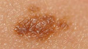 Skin Cancer: Skin Cancer On Face Pictures Skin Cancer  
