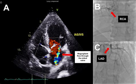 Cureus Prosthetic Mitral Valve Thrombosis A Complication Following Mitral Valve Surgery And