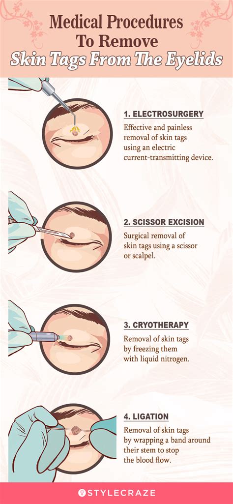 How To Remove Skin Tags From The Eyelids And Prevention Tips