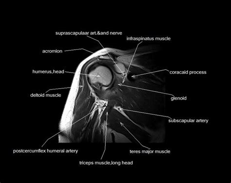 Start studying shoulder anatomy diagram. MRI shoulder anatomy | shoulder coronal anatomy | free ...
