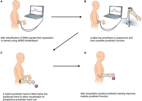 Frontiers Rehabilitation Of Upper Extremity Nerve Injuries Using Surface Emg Biofeedback