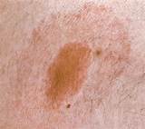 Lyme Disease Rash Itch Treatment Images