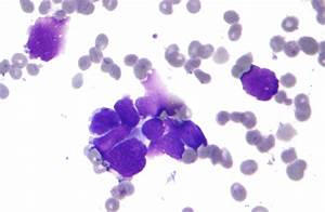 File:Small cell lung cancer - cytology.jpg - Wikipedia Lung Cancer  