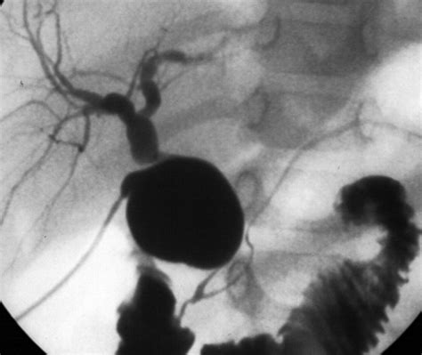 Operative Cholangiogram Of Type 1c Malformation With Clear Demarcation