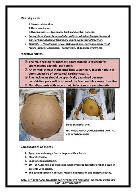 Build Up Of Fluid In The Abdomen Ascites And Infection Of The Fluid