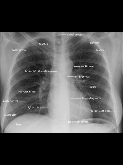 Chest Xray Annotation Medical Anatomy Diagnostic Imaging Medical