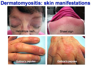 Dermatomyositis Shawl Sign Rash Hot Sex Picture