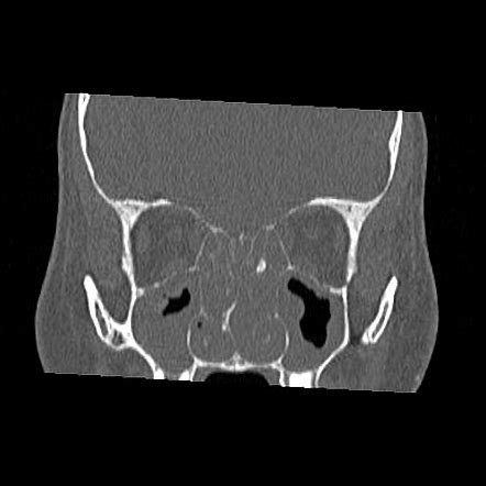 Sinonasal Polyposis With Small Ethmoidal Osteoma Radiology Case