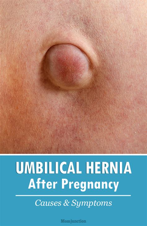 Hernia After Pregnancy Symptoms Prevention And Treatment Hernia In