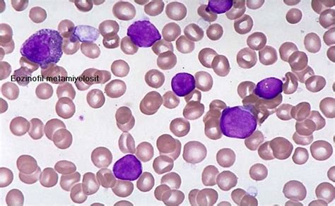 Acute Lymphoblastic Leukemia Classification Wikidoc