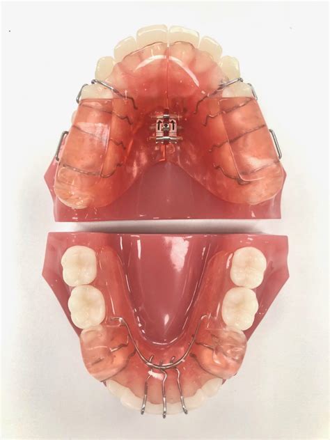 Twin Block Beugelcategorie 3 Orthodontiepraktijk Den Helder