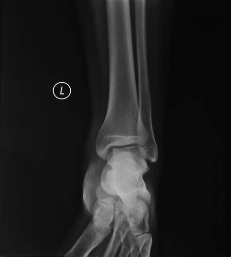 Ankle Fractures Trauma